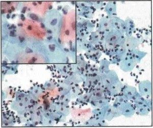 LOW SIL (an infection by Human Papilloma Virus)